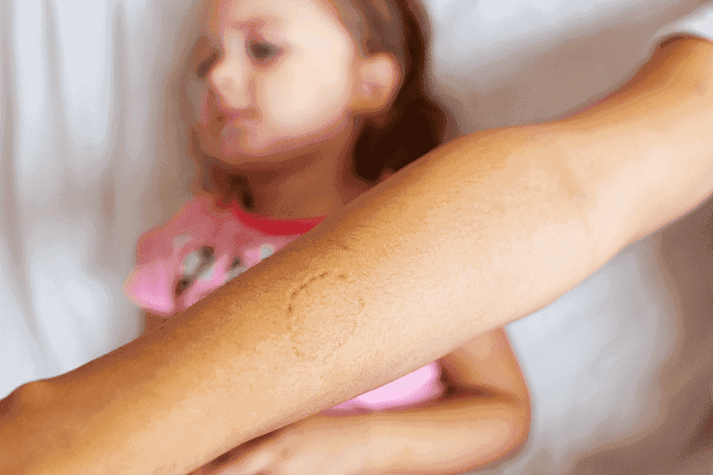 Braço com um mordida feito por uma criança